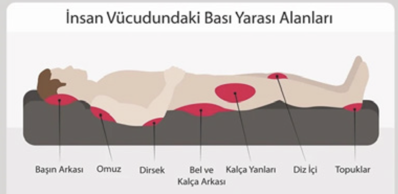 Başın arkası, omuz, dirsek, bel ve kalça, diz içi ve topuklardaki basınç bölgelerini gösteren şema
